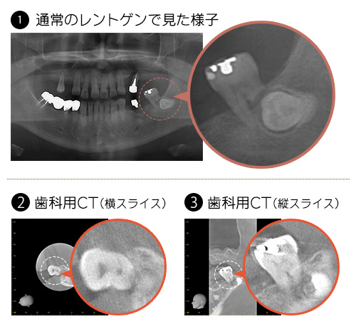歯科用CTでの診察例